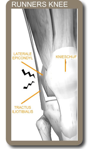 runners-knee-1